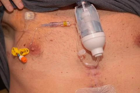 Close up of persons stomach with plastic bottle attached Stock Photos