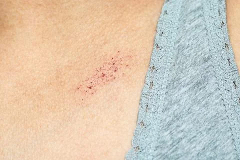 Close-up of petechiae showing capillary bleeding on skin 库存照片