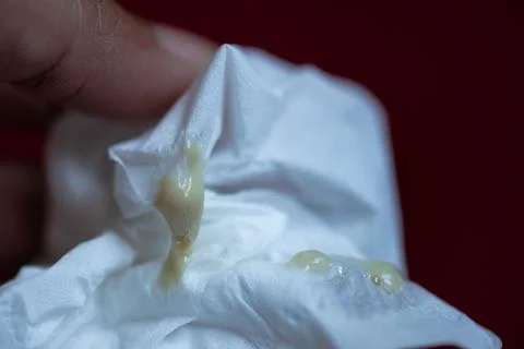 Close Up of Phlegm on White Tissue After Productive Cough Stock Photos