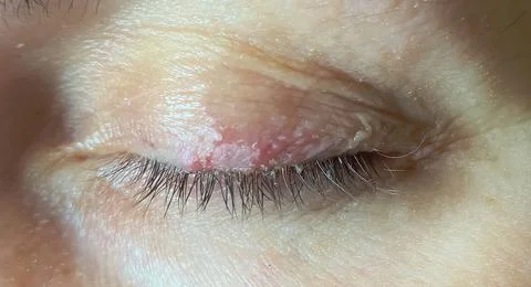 Close-up photography, selective focus, dermatological infection of the skin Stock Photos
