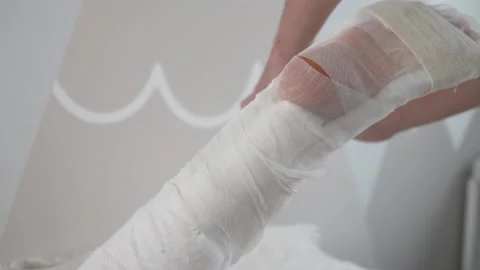 Close-up of plaster langette dressing after surgery to stitch the Achilles Stock Footage 150995963