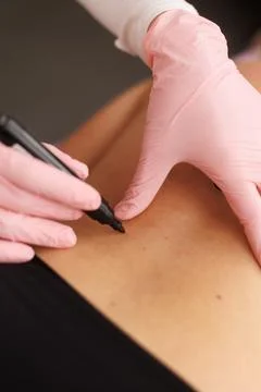 Close up of plastic surgeon using marker pen while marking body of fat woma.. Stock Photos
