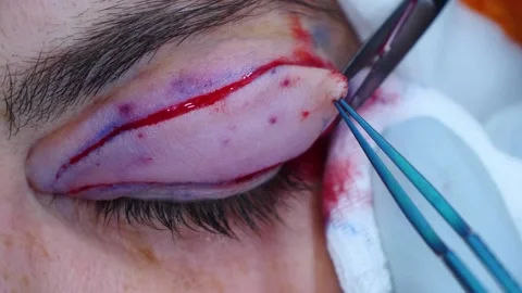 Close-up of a plastic surgery. A surgeon removing piece of skin from eyelid Video stock 145603003