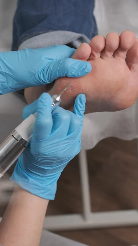 Close up podologist uses electric drill on woman foot to remove callus Stock Footage 273880135