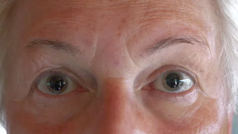 CLOSE UP, PORTRAIT: Dilated pupils of an elderly woman after an eye examination 스톡 동영상 302651220