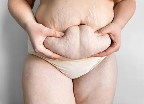 Close up of postpartum belly with stretch marks held by hands. Real womans body Stock Photos