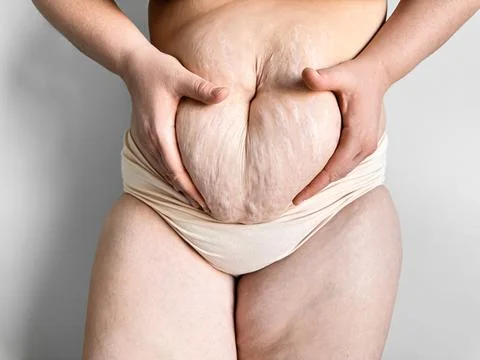 Close up of postpartum belly with stretch marks held by hands. Real womans body Foto stock