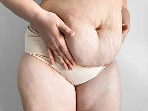 Close up of postpartum belly with stretch marks, promoting body positivity and Stock Photos
