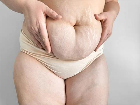 Close up of postpartum belly with stretch marks, promoting body positivity and Foto stock