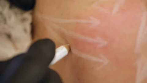 Close-up preparation of the face for cosmetic plastic surgery. Stock Footage 107357889