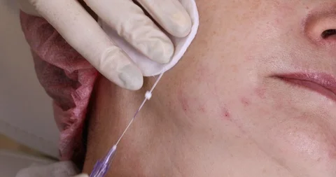 Close-up of procedure for face lifting PDO Suture operation, Stock Footage 102028354