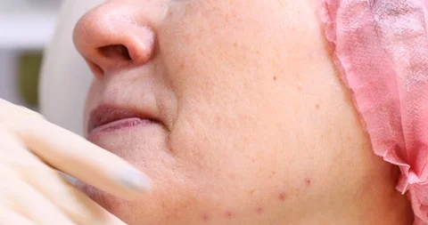 Close-up of procedure for face lifting PDO Suture operation, Stock Footage 102028515