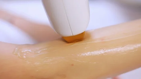 Close-up procedure of removing hairs on hand. Laser hair removal on a diode Video stock 99924813