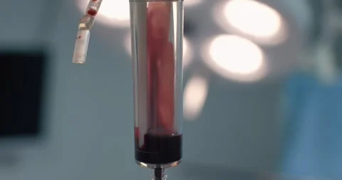 Close-up of the process of blood transfusion through the intravenous system. In Stock Footage 276414306