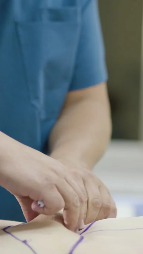 Close-up of a professional marking reference lines on a patient Stock Footage 345703570