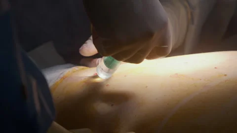 Close up of professional surgeon inserting injection of anesthesia Stock Footage 252721617