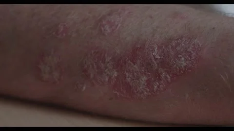Close up of psoriasis on arm Stock Footage 135899711
