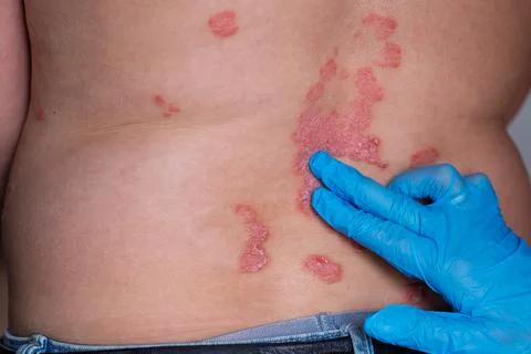 Close-up of psoriasis lesions on a person's back, with a healthcare profess.. Foto stock