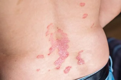 Close-up of psoriasis patches on the lower back of a person, showcasing red.. Foto stock