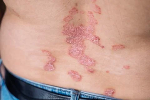 Close-up of psoriasis patches on the lower back of a person wearing blue je.. Stock Photos