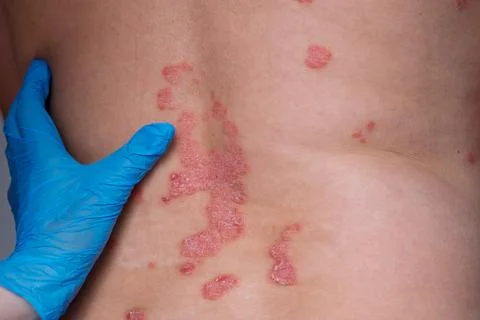 Close-up of psoriasis skin condition on the back with a gloved hand examini.. Foto stock
