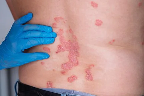 Close-up of psoriasis skin condition on the back of a person with gloved ha.. Foto stock