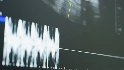 Close Up of Radiography Imaging Device Showing Faint Angular Wave Movement Stock Footage 306034319