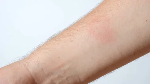 Close-up of a red allergic rash and skin irritation on a patient hand. Stock Footage 337348652