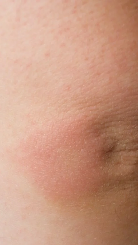 Close-up of a red allergic rash and skin irritation on a human skin. Stock Footage 337348978