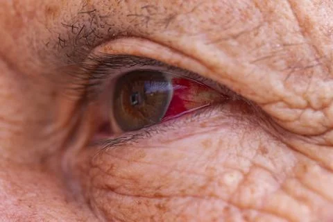 Close up of red eye or or bloodshot eyes Stock Photos