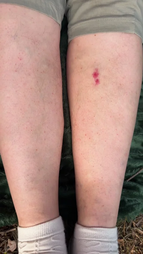 Close-up of a red insect bite on the lower leg, skin irritation Vídeo Stock 337775072