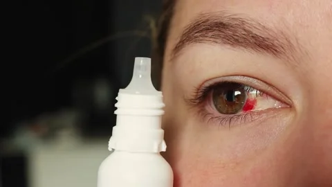 Close-up of red irritated eye receiving eye drops from a white bottle Stock Footage 340261160