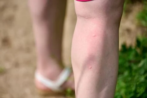 Close-up of red mosquito bite on leg in sunlit outdoors Stock Photos