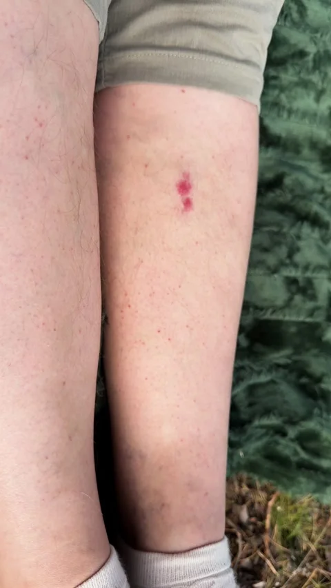 Close-up of a red mosquito or midge bite on a person's lower leg outdoors Stock-Footage 337774929