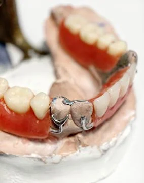 Close-up of removable partial denture on plaster mold 库存照片
