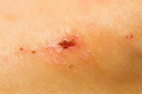 Close up of a scar Stock Photos