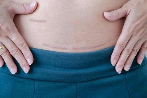 Close-up of scars after appendix surgery. and postpartum surgical wounds Stock Photos