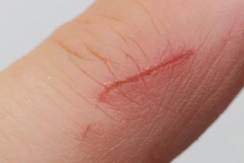 Close-up of a scratch on a finger. 스톡 사진