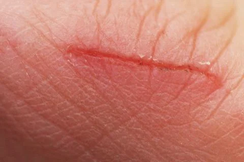 Close-up of a scratch on a finger. Stock Photos