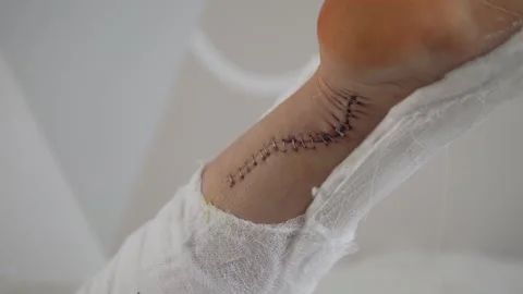Close-up of the seam with braces on the leg after surgery on the Achilles tendon Stock Footage 150886760