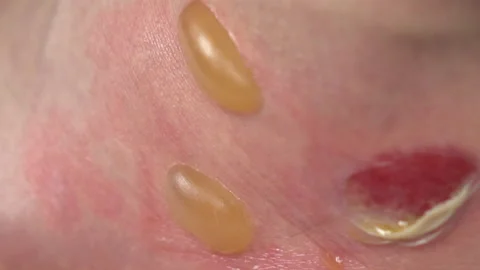 A close-up of a second-degree burn of a man's leg with hot water. The skin Stock Footage 142512448