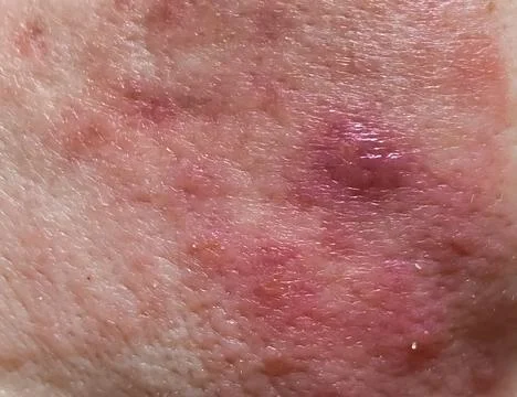Close-up, selective focus, dermatological infection of the skin, in which Stock Photos