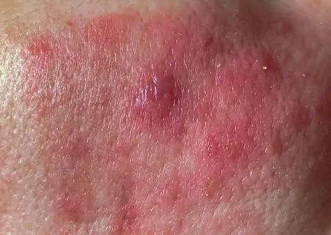 Close-up, selective focus, dermatological infection of the skin, in which Stock Photos