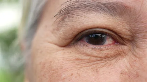 Close up of the senile cataract during eye examination. A white cloudy disc i Stock Footage 204793559