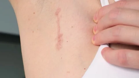 Close-up sequence of skin scar under armpit after lymph node removal, showcasing Video stock 315573608