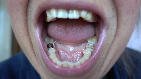 Close up set of teeth with a decayed tooth Stock Footage 108387126