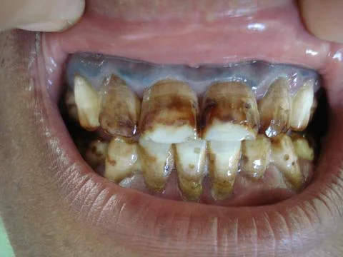 Close-up of severe tooth stains Stock Photos