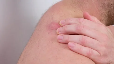 Close-up of a shirtless man's hand touching a large, red, and inflamed atheroma Video stock 337723328