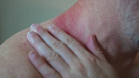 Close shoot up of red sunburned skin on the neck of an adult after prolonged Stock-Footage 340382847