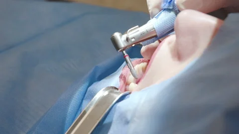 Close-up shot of attentive doctors performing surgical operation installing Video stock 194461879